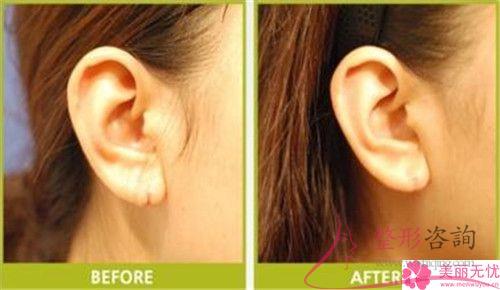 <a href=http://m.f3bb6.cn/listinfo-698-0.html target=_blank class=infotextkey>招風耳矯正</a>手術可以使用免拆除的縫線嗎