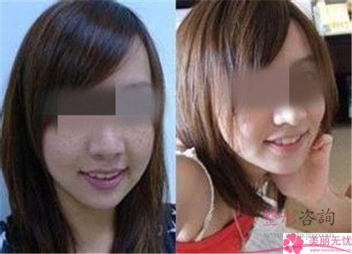 點陣激光祛色斑要經歷多久治療周期