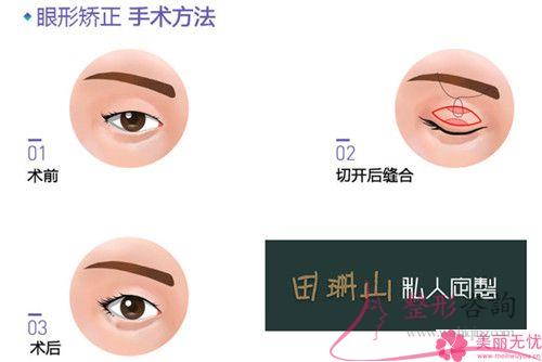 做飛秒治療近視眼手術(shù)前能不能化淡妝