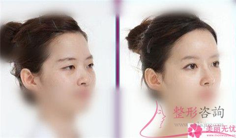 小切口去除額頭皺紋后觀察3個小時就可回家了嗎