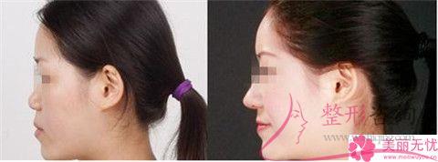 小切口去除額頭皺紋后觀察3個小時就可回家了嗎