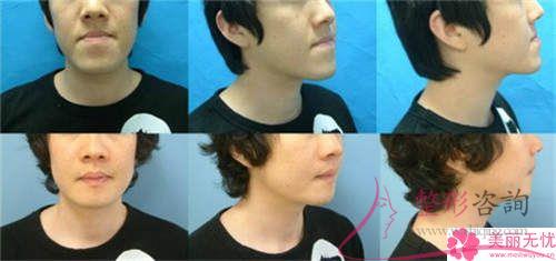 <a href=http://m.f3bb6.cn/listinfo-629-0.html target=_blank class=infotextkey>下頜角</a>截骨手術的費用在12154-21849元之間嗎