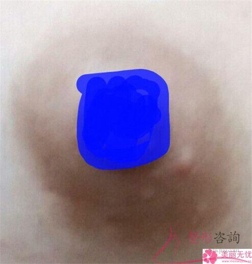 女性在做乳暈激光漂紅可能會遇到的風險多嗎