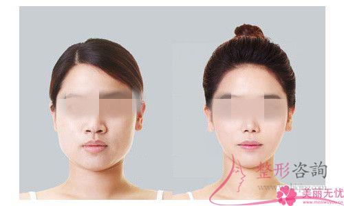 泉州做一次面部埋線提升需要用到多少人民幣