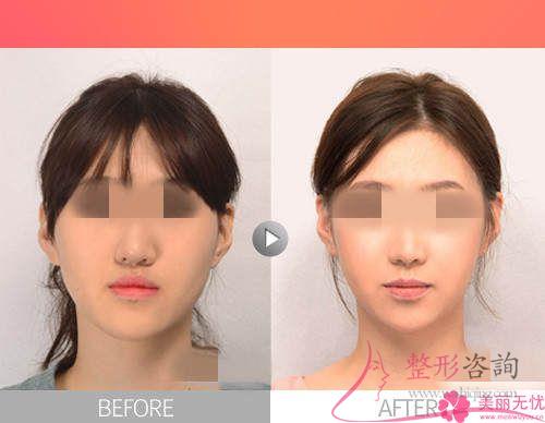 <a href=http://m.f3bb6.cn/listinfo-629-0.html target=_blank class=infotextkey>下頜角</a>手術可以矯正下頜太寬嗎