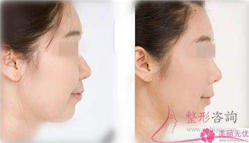 <a href=http://m.f3bb6.cn/listinfo-629-0.html target=_blank class=infotextkey>下頜角</a>手術可以矯正下頜太寬嗎