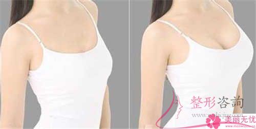 假體<a href=http://m.f3bb6.cn/listinfo-618-0.html target=_blank class=infotextkey>隆胸</a>整形手術費用大約具體是多少？