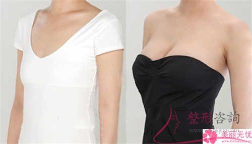 假體<a href=http://m.f3bb6.cn/listinfo-618-0.html target=_blank class=infotextkey>隆胸</a>費用大致是多少？