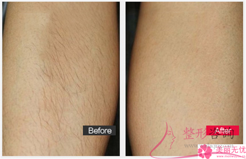 冰點<a href=http://m.f3bb6.cn/listinfo-665-0.html target=_blank class=infotextkey>脫唇毛</a>會再生長或越長越黑嗎