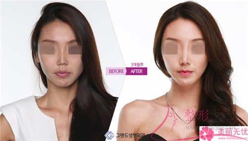 短鼻延長術(shù)通常來說適合于哪種人