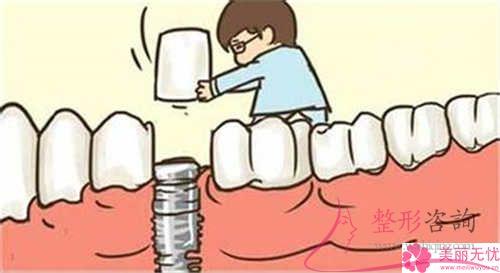 究竟哪種材料的種植牙比較昂貴？功能和效果究竟好不好呢