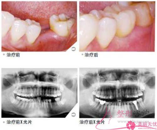 究竟哪種材料的種植牙比較昂貴？功能和效果究竟好不好呢