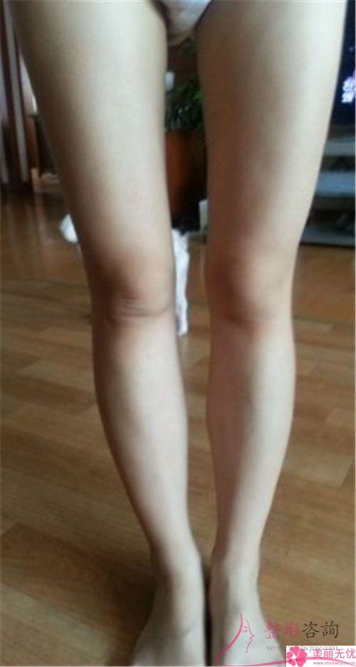 自體脂肪<a href=http://m.f3bb6.cn/listinfo-677-0.html target=_blank class=infotextkey>豐臀</a>術(shù)的4個好處