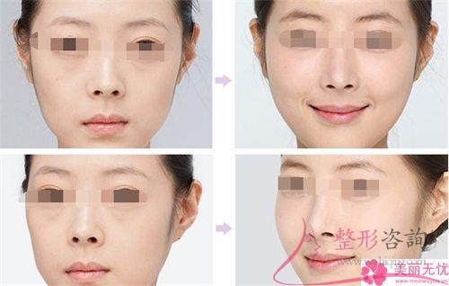 <a href=http://m.f3bb6.cn/listinfo-737-0.html target=_blank class=infotextkey>隆鼻</a>術整形效果有哪些