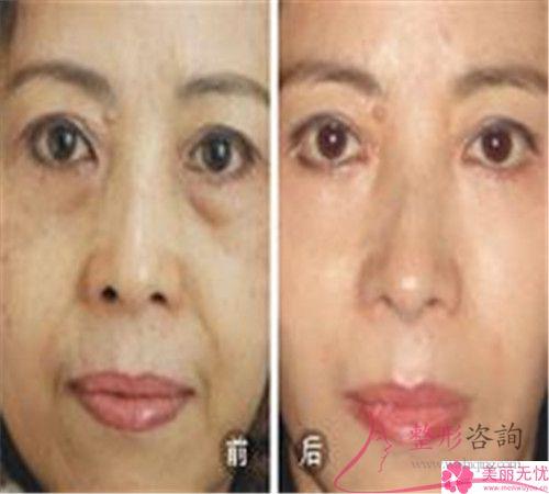非手術<a href=http://m.f3bb6.cn/listinfo-614-0.html target=_blank class=infotextkey>除皺</a>和手術<a href=http://m.f3bb6.cn/listinfo-614-0.html target=_blank class=infotextkey>除皺</a>貴不貴