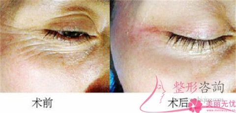 魚尾紋祛除29675足夠嗎？用<a href=http://m.f3bb6.cn/listinfo-610-0.html target=_blank class=infotextkey>熱瑪吉</a>