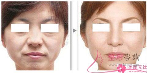 魚尾紋祛除29675足夠嗎？用<a href=http://m.f3bb6.cn/listinfo-610-0.html target=_blank class=infotextkey>熱瑪吉</a>