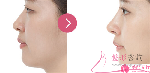 鼻中隔軟骨<a href=http://m.f3bb6.cn/listinfo-737-0.html target=_blank class=infotextkey>隆鼻</a>的費用大概得花多少錢