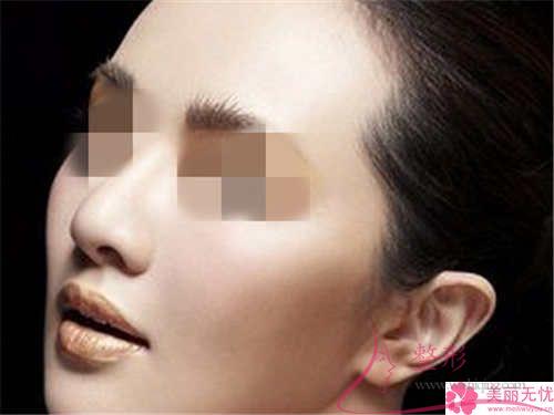 鼻中隔軟骨<a href=http://m.f3bb6.cn/listinfo-737-0.html target=_blank class=infotextkey>隆鼻</a>的費用大概得花多少錢