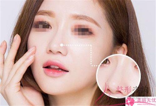 鼻子肥做縮小鼻子變小效果是終身的嗎