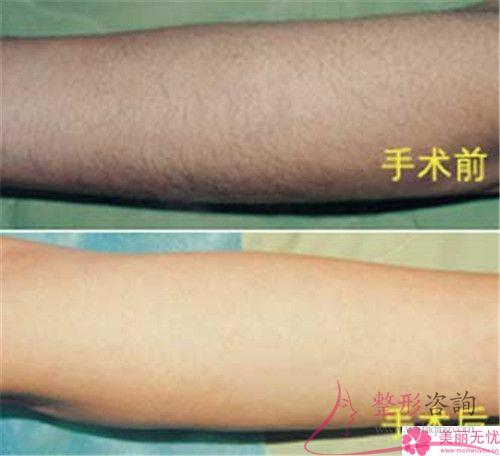 女生小胡子<a href=http://m.f3bb6.cn/listinfo-670-0.html target=_blank class=infotextkey>脫毛</a>選冰點有哪些優點