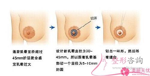 女性實施<a href=http://m.f3bb6.cn/listinfo-625-0.html target=_blank class=infotextkey>乳暈縮小</a>手術(shù)的成功率是100%嗎
