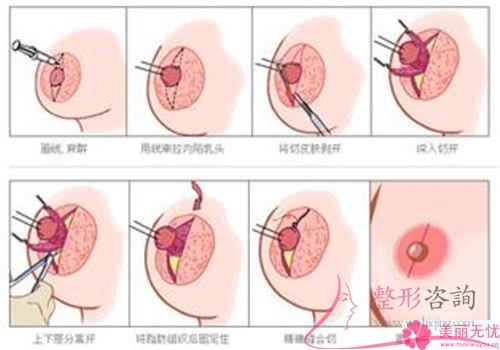 女性實施<a href=http://m.f3bb6.cn/listinfo-625-0.html target=_blank class=infotextkey>乳暈縮小</a>手術(shù)的成功率是100%嗎