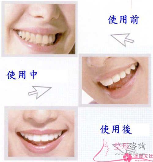 牙齒修復(fù)顆牙齒要準(zhǔn)備多少？