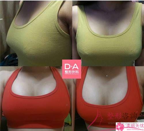 硅膠假體<a href=http://m.f3bb6.cn/listinfo-618-0.html target=_blank class=infotextkey>隆胸</a>手術之后哪些事情能夠幫助大伙速度恢復？大概多久能康復？