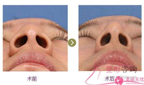縮小<a href=http://m.f3bb6.cn/listinfo-754-0.html target=_blank class=infotextkey>鼻翼</a>怎么避免瘢痕增生