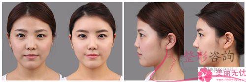 膨體聚四氟乙烯<a href=http://m.f3bb6.cn/listinfo-737-0.html target=_blank class=infotextkey>隆鼻</a>術好長時間會回軟？有并發癥嗎？