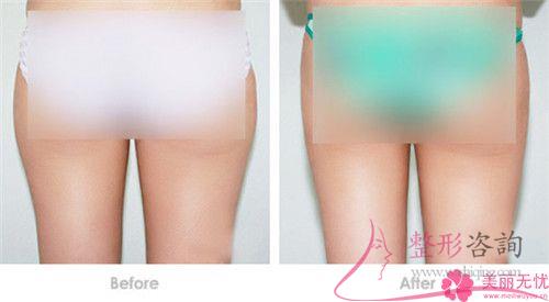 自體<a href=http://m.f3bb6.cn/listinfo-677-0.html target=_blank class=infotextkey>豐臀</a>的優(yōu)點