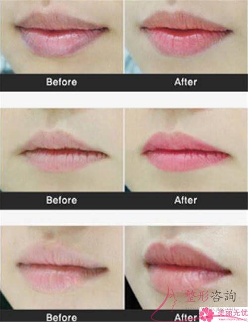 重唇矯正術是不是會非常疼