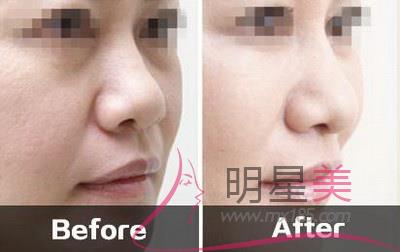 手術傷疤能消除嗎