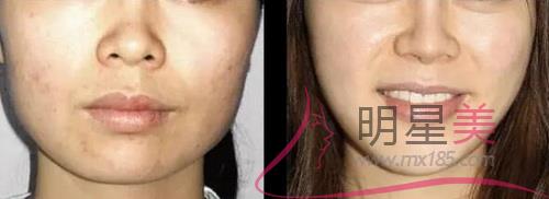 <a href=http://m.f3bb6.cn/listinfo-733-0.html target=_blank class=infotextkey>肉毒素</a>打咬肌注意事項