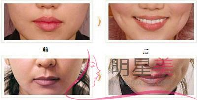 快速臉上傷疤好