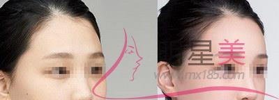 打完<a href=http://m.f3bb6.cn/listinfo-631-0.html target=_blank class=infotextkey>瘦臉</a>臉部凹陷下垂