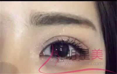 種植眉毛會掉嗎