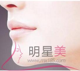 什么是假體豐下巴恢復?