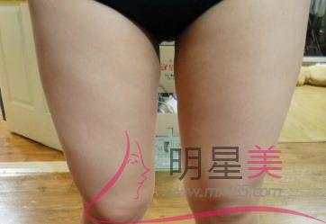 拉伸能消除肌肉小腿嗎