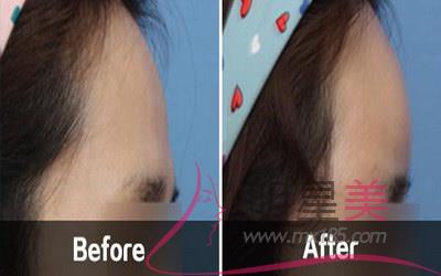 孩子臉上有紅胎菊能治好嗎