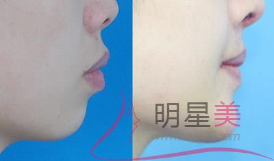 小孩子臉上好多小紅點