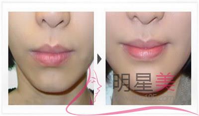 假體豐下巴恢復過程和圖片