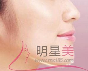 怎么看蘋果肌是復位還是填充