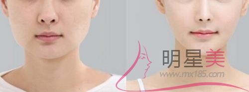 怎么塑造蘋果肌
