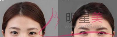 額頭上長(zhǎng)了小疙瘩是怎么回事