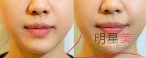 膠原蛋白填充額頭一個包