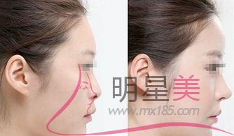 打<a href=http://m.f3bb6.cn/listinfo-731-0.html target=_blank class=infotextkey>玻尿酸</a>什么用