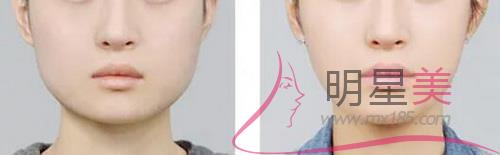 側臉很丑怎么改善