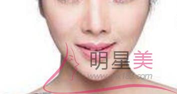 自體脂肪<a href=http://m.f3bb6.cn/listinfo-643-0.html target=_blank class=infotextkey>豐額頭</a>恢復期多久